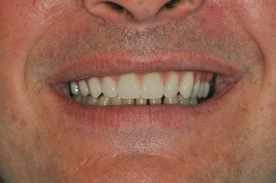 teeth in a day - after